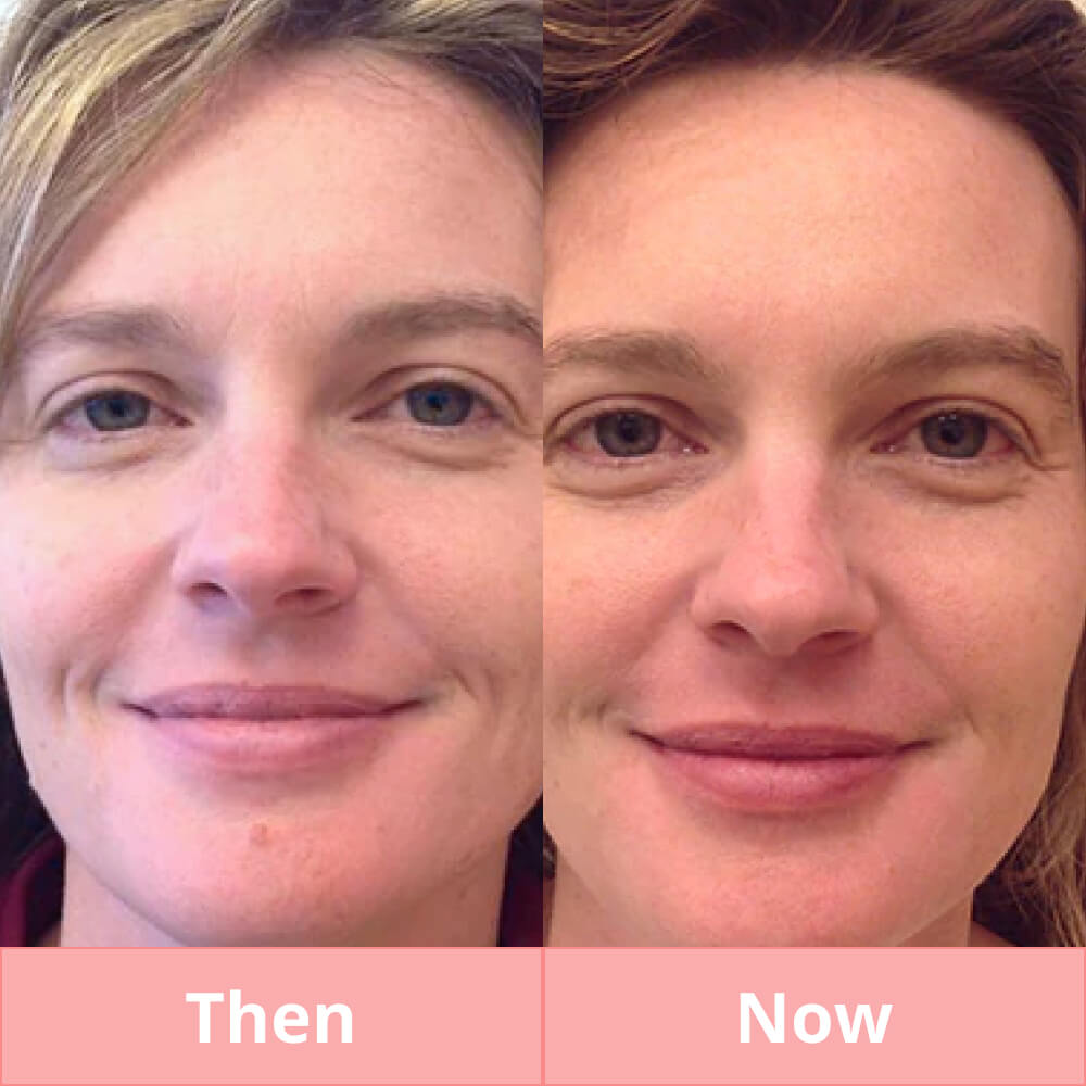 Skin Tag & Mole Remover Pen - Plasma Pen for Freckle, Skin Tag, Spot & Mole Removal