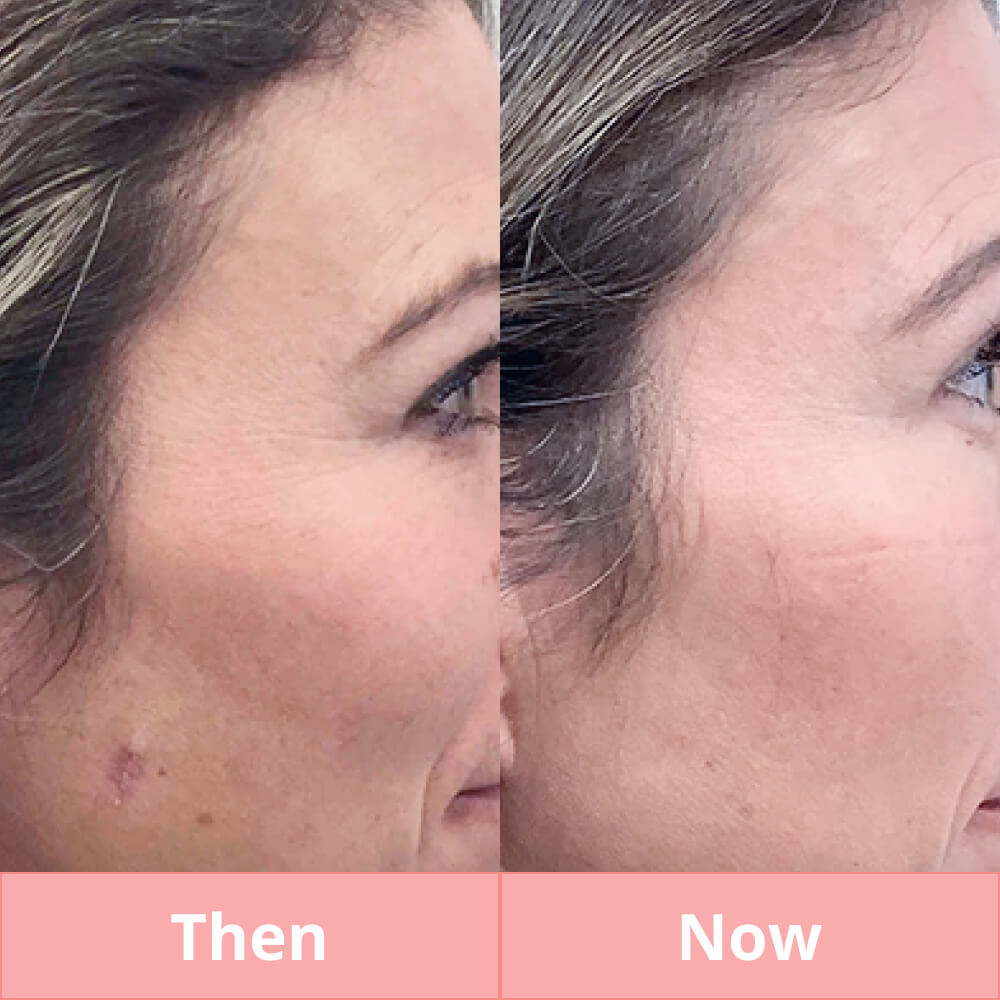 Skin Tag & Mole Remover Pen - Plasma Pen for Freckle, Skin Tag, Spot & Mole Removal