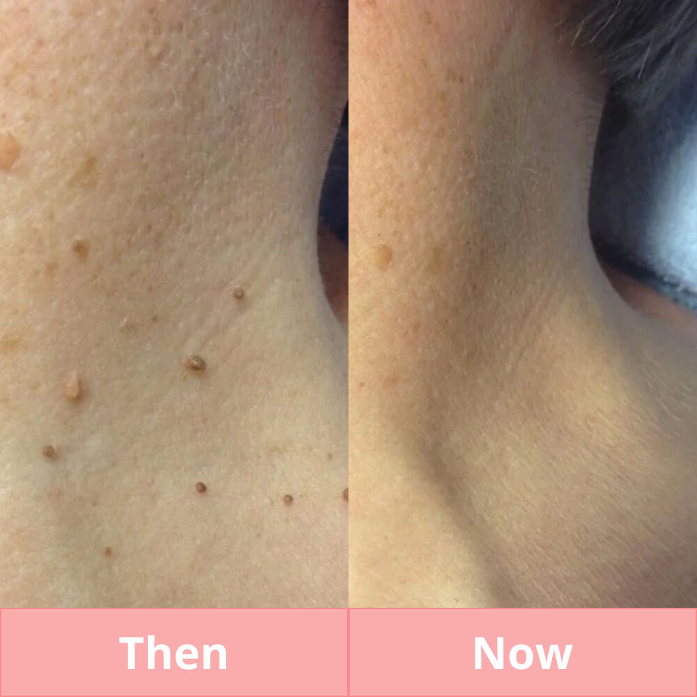 Skin Tag & Mole Remover Pen - Plasma Pen for Freckle, Skin Tag, Spot & Mole Removal