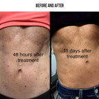 Plasma Pen for Skin Tag, Mole & Wart Removal | 9 Intensity Levels, Bloodless & User-Friendly for At-Home Treatments