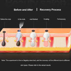 Plasma Pen for Skin Tag, Mole & Wart Removal | 9 Intensity Levels, Bloodless & User-Friendly for At-Home Treatments