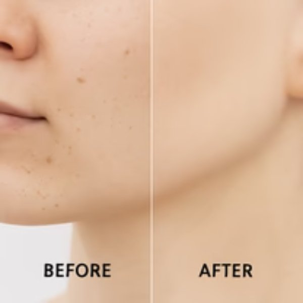 Blue Light Therapy Laser Pen | Acne, Dark Spot & Spider Vein Treatment for Safe At-Home Skin Care