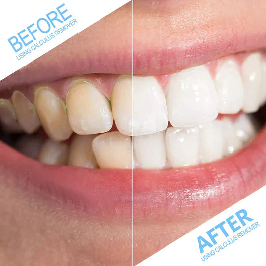 Dental Calculus Remover | Effective Plaque & Tartar Cleaner for Home Oral Care