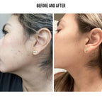 Plasma Pen for Skin Tag, Mole & Wart Removal | 9 Intensity Levels, Bloodless & User-Friendly for At-Home Treatments