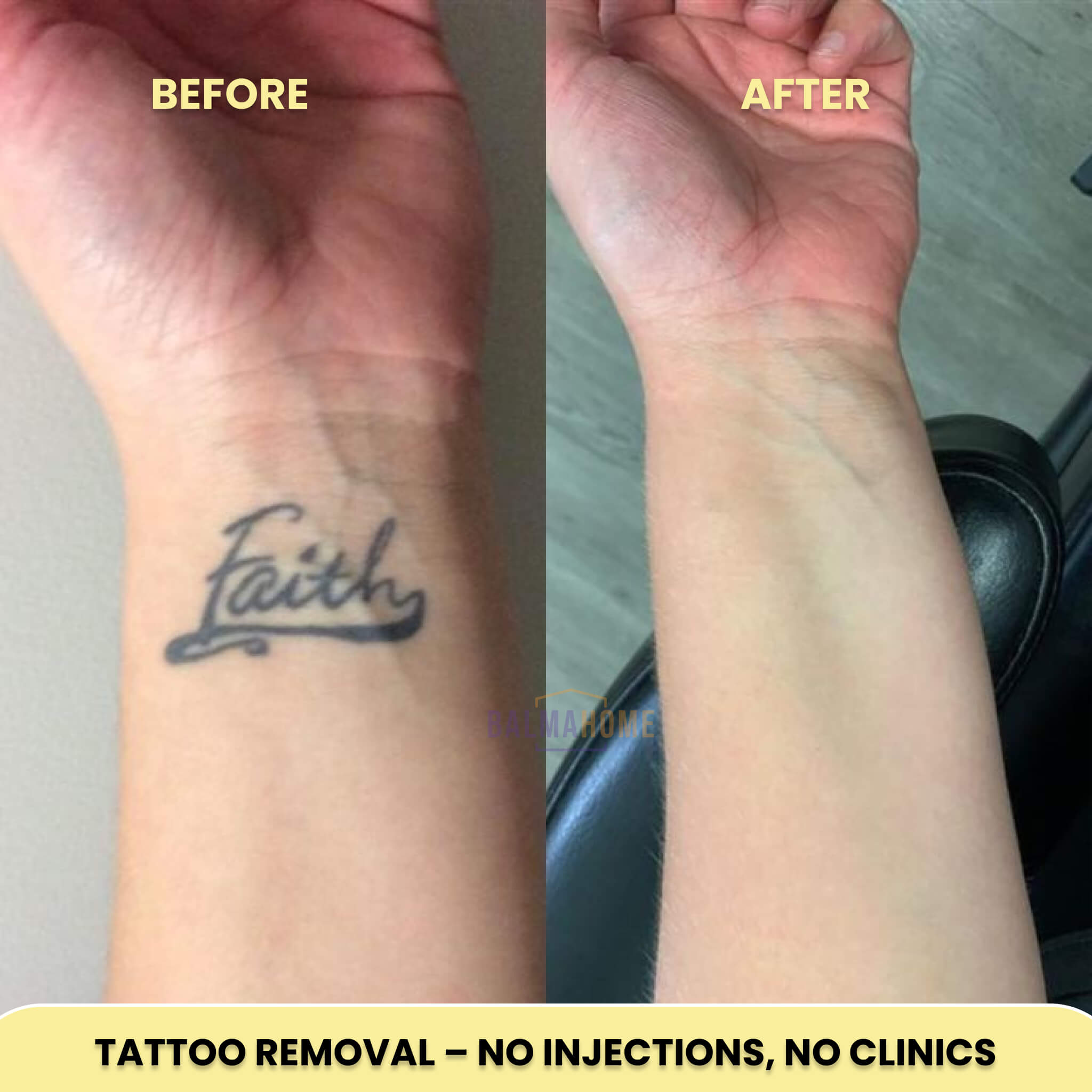 Tattoo Removal Laser Pen | Safe, Effective Blue Light Therapy for At-Home Ink Fading and Skin Confidence