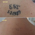 Tattoo Removal Laser Pen | Safe, Effective Blue Light Therapy for At-Home Ink Fading and Skin Confidence