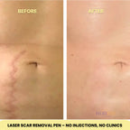 Laser Scar Removal Pen | Painless, Adjustable Intensity for Acne, Burn & Surgical Scars at Home