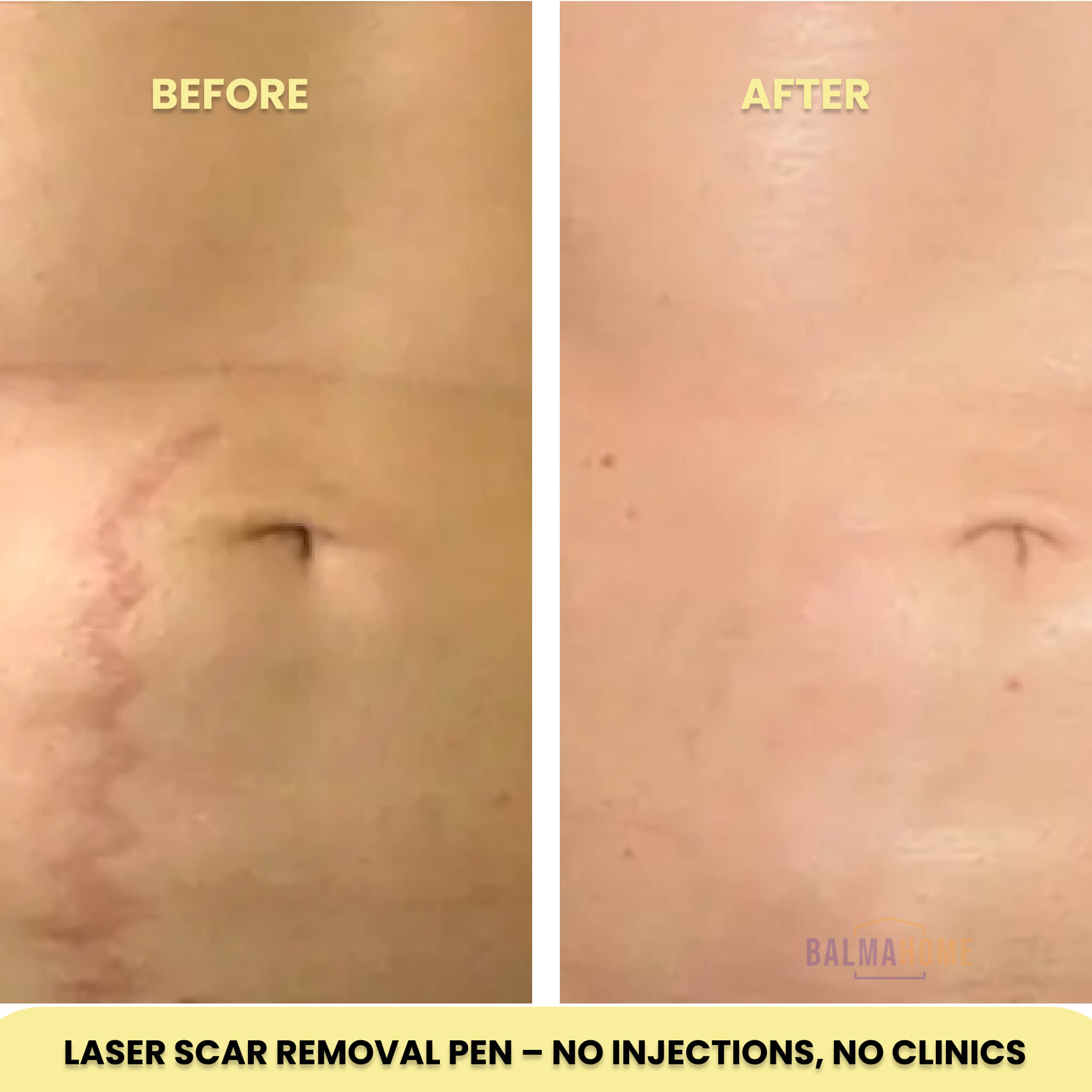 Laser Scar Removal Pen | Painless, Adjustable Intensity for Acne, Burn & Surgical Scars at Home