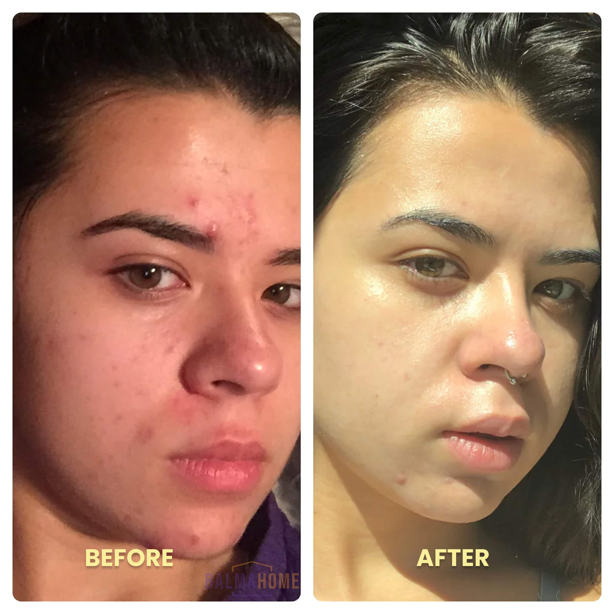 Laser Scar Removal Pen | Painless, Adjustable Intensity for Acne, Burn & Surgical Scars at Home