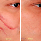 Laser Scar Removal Pen | Painless, Adjustable Intensity for Acne, Burn & Surgical Scars at Home