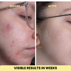 Laser Scar Removal Pen | Painless, Adjustable Intensity for Acne, Burn & Surgical Scars at Home