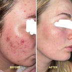 Laser Scar Removal Pen | Painless, Adjustable Intensity for Acne, Burn & Surgical Scars at Home