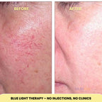 At-Home Blue Light Therapy Device | Non-Invasive Treatment for Spider & Varicose Veins, Portable & Rechargeable for Clearer Skin