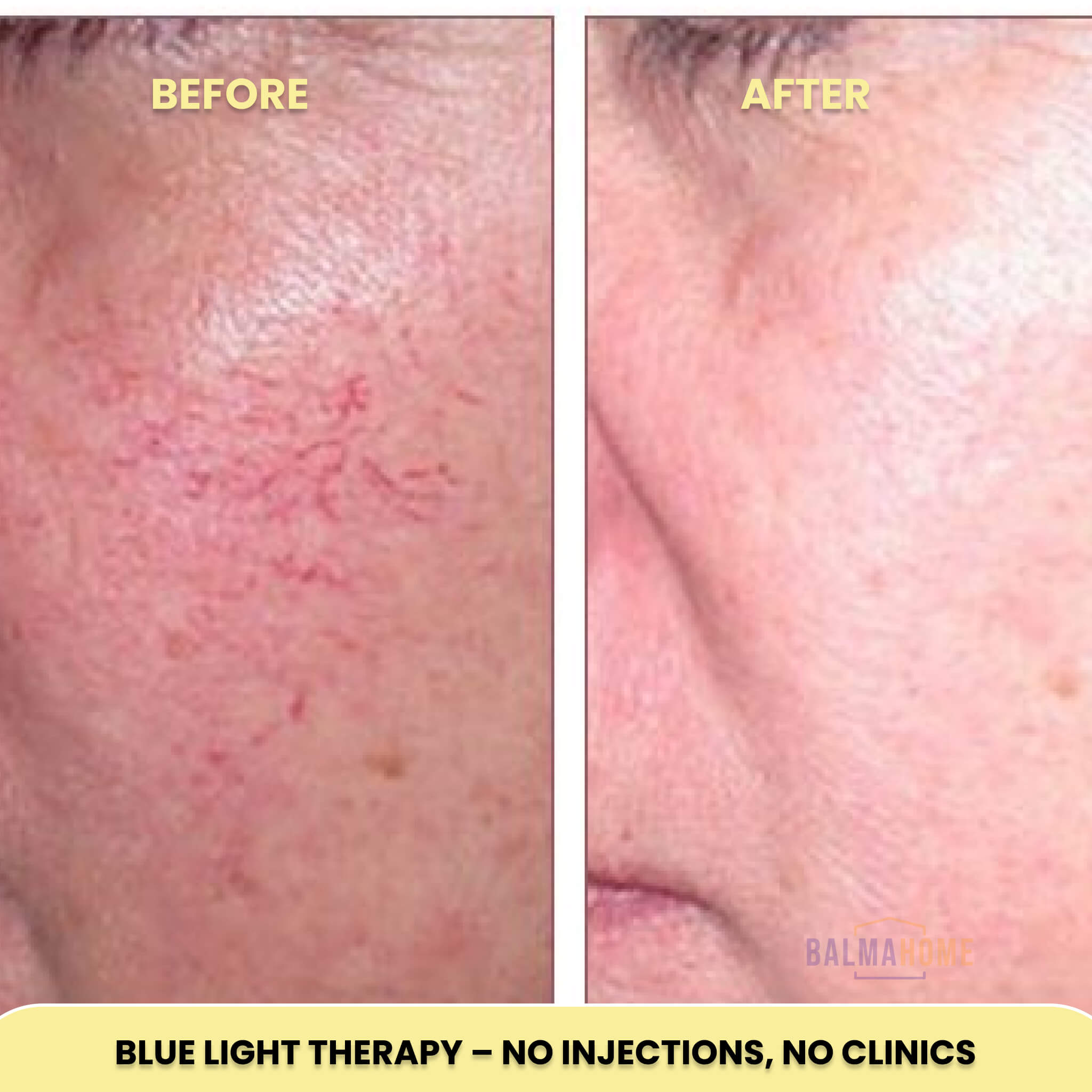 At-Home Blue Light Therapy Device | Non-Invasive Treatment for Spider & Varicose Veins, Portable & Rechargeable for Clearer Skin