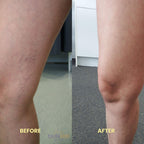 At-Home Blue Light Therapy Device | Non-Invasive Treatment for Spider & Varicose Veins, Portable & Rechargeable for Clearer Skin