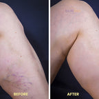 At-Home Blue Light Therapy Device | Non-Invasive Treatment for Spider & Varicose Veins, Portable & Rechargeable for Clearer Skin