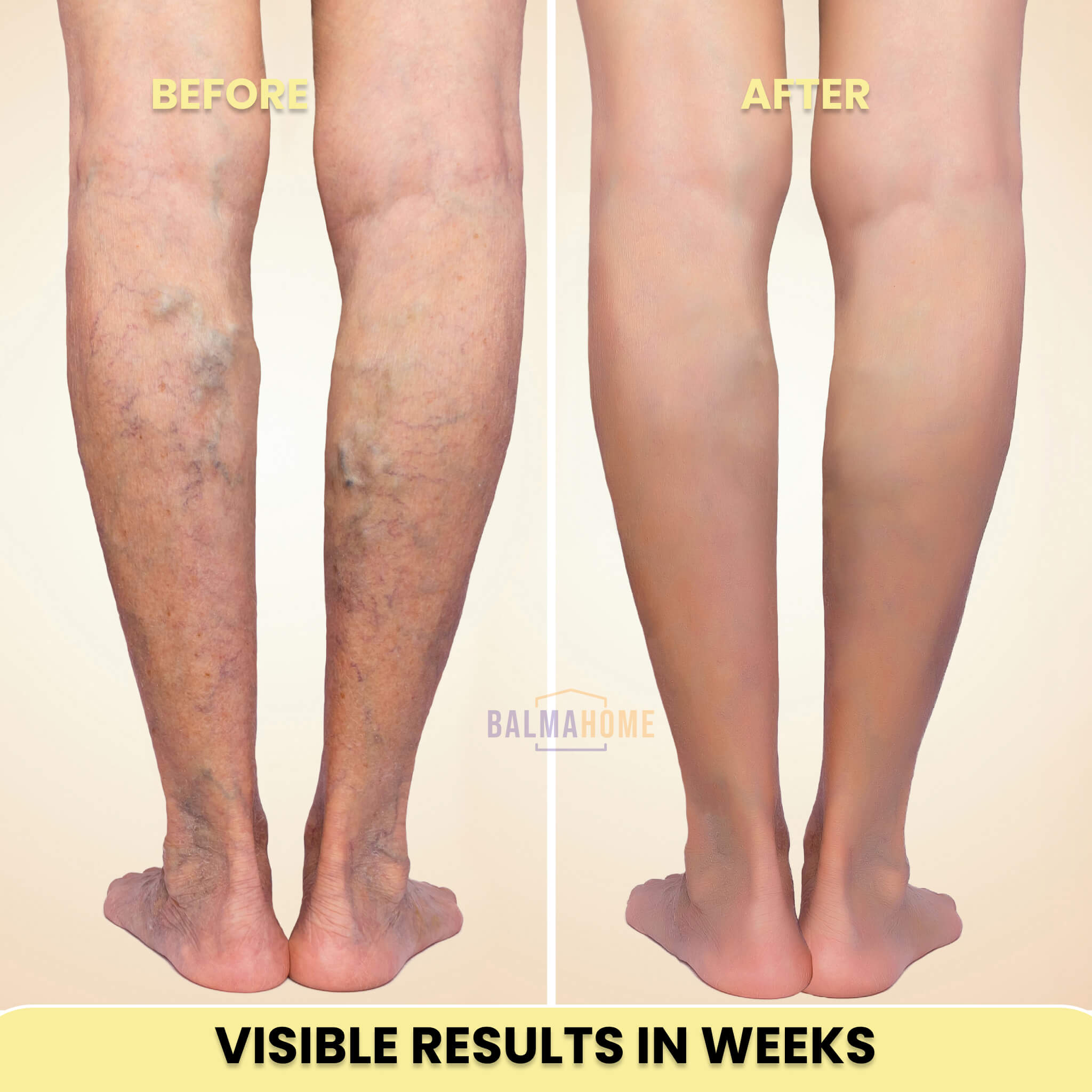 At-Home Blue Light Therapy Device | Non-Invasive Treatment for Spider & Varicose Veins, Portable & Rechargeable for Clearer Skin