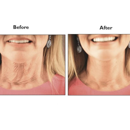 The Instant Neck Lift l No Pain Neck Lift Stretch Bands