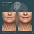 Ultra-Light LED Phototherapy Mask | Near-Infrared & Red Light for Deep Wrinkle Support & Anti-Aging Treatment