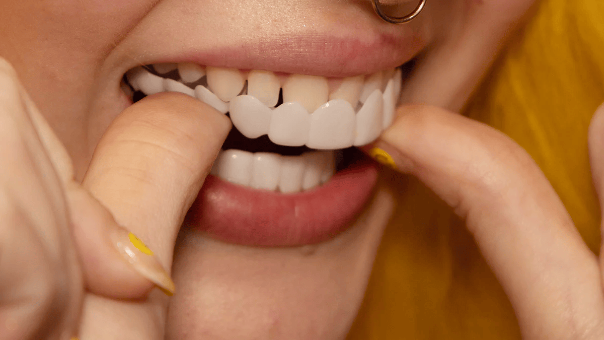 Snap-On Smile Veneers | Customizable, Easy-to-Use & Affordable Solution for Instant Smile Transformation