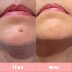 Skin Tag & Mole Remover Pen - Plasma Pen for Freckle, Skin Tag, Spot & Mole Removal