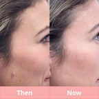 Skin Tag & Mole Remover Pen - Plasma Pen for Freckle, Skin Tag, Spot & Mole Removal